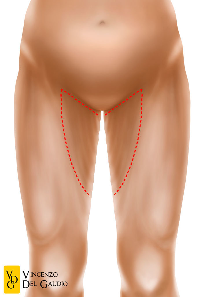 illustrazione lifting delle cosce 02