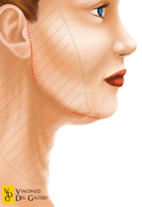 illustrazione mini-lifting 02