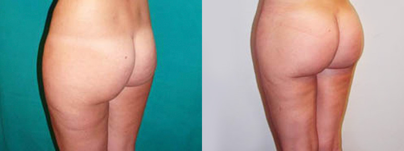 Gluteoplastica Foto Interventi 01