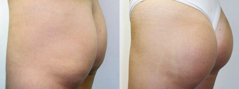 Gluteoplastica Foto Interventi 02
