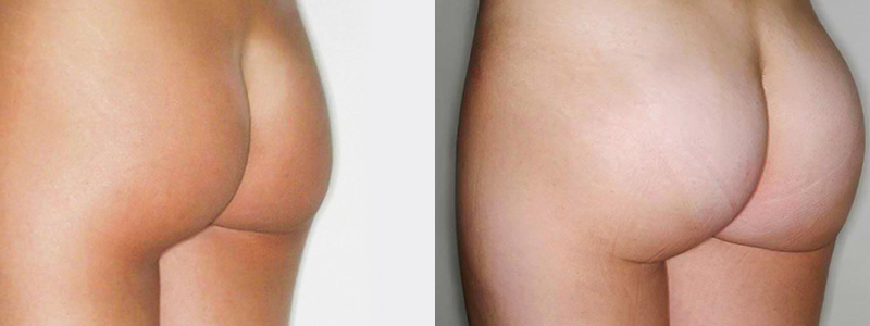 Gluteoplastica Foto Interventi 03