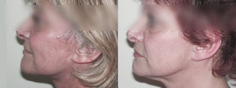 Lifting Viso Collo Foto Interventi 01