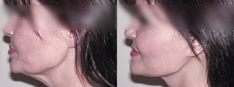 Lifting Viso Collo Foto Interventi 02