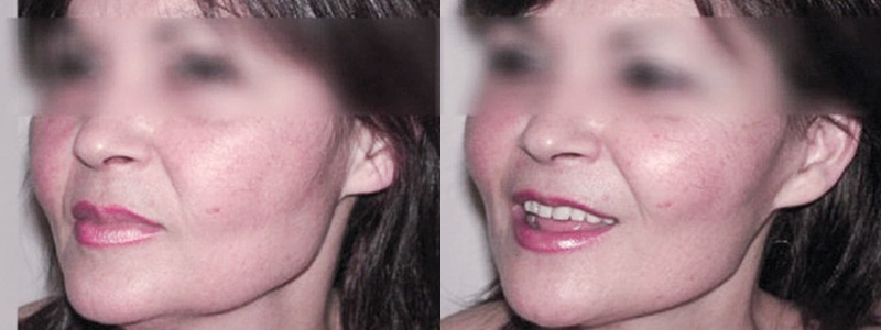 Lifting Viso Collo Foto Interventi 03