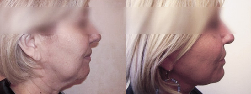 Lifting Viso Collo Foto Interventi 05