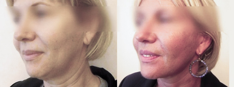 Lifting Viso Collo Foto Interventi 06