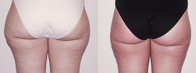 Liposuzione Foto Interventi 01