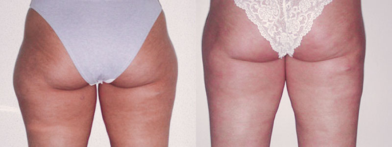 Liposuzione Foto Interventi 05