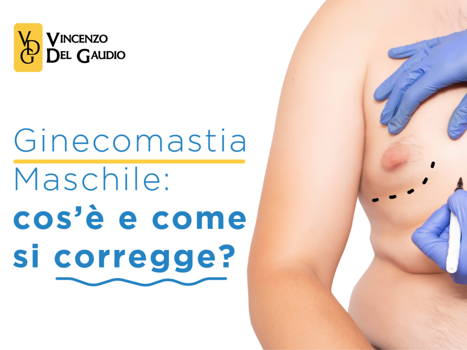 ginecomastia maschile cose e come si corregge