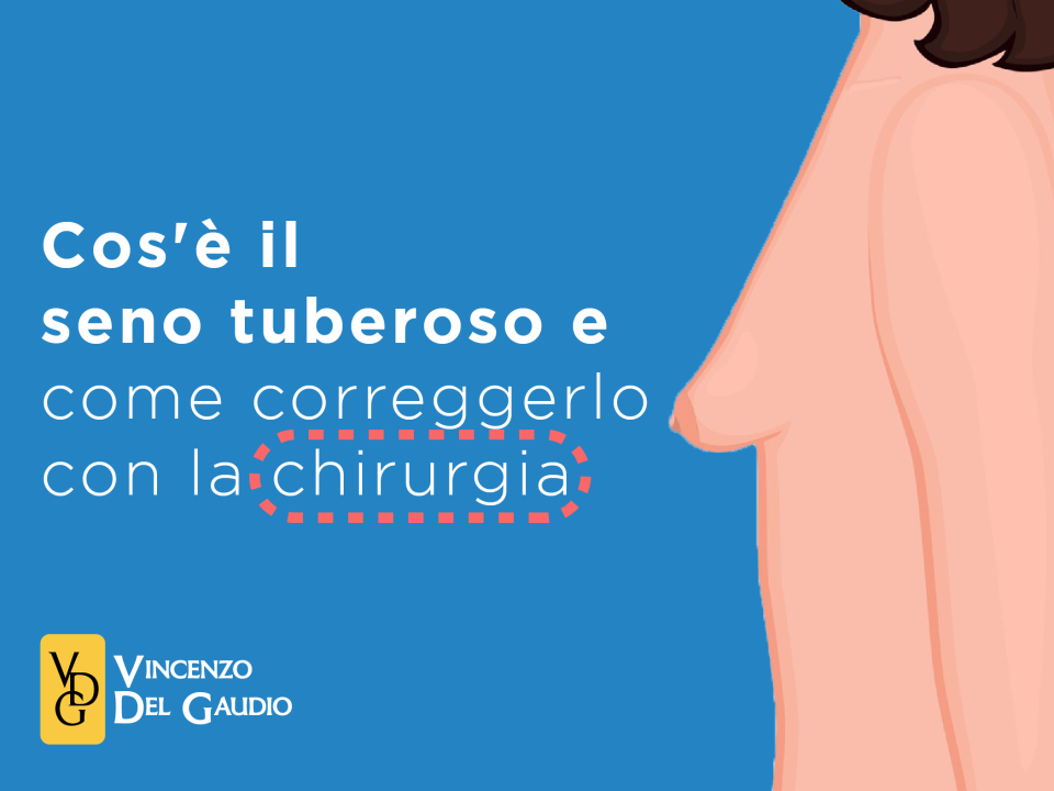 cos'è il seno tuberoso
