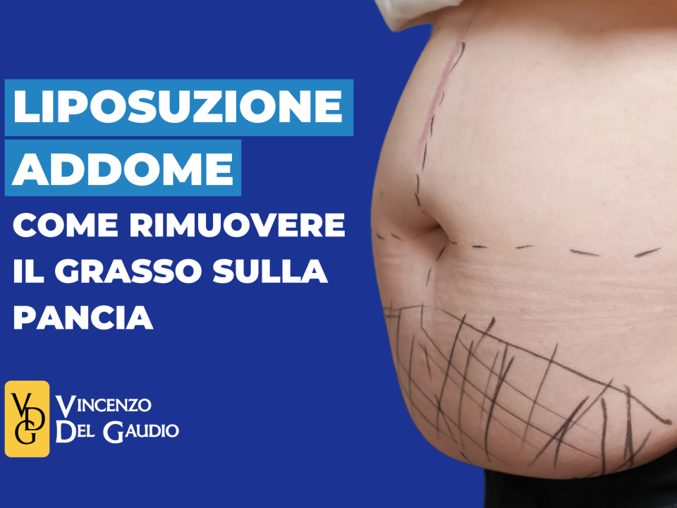 liposuzione addome